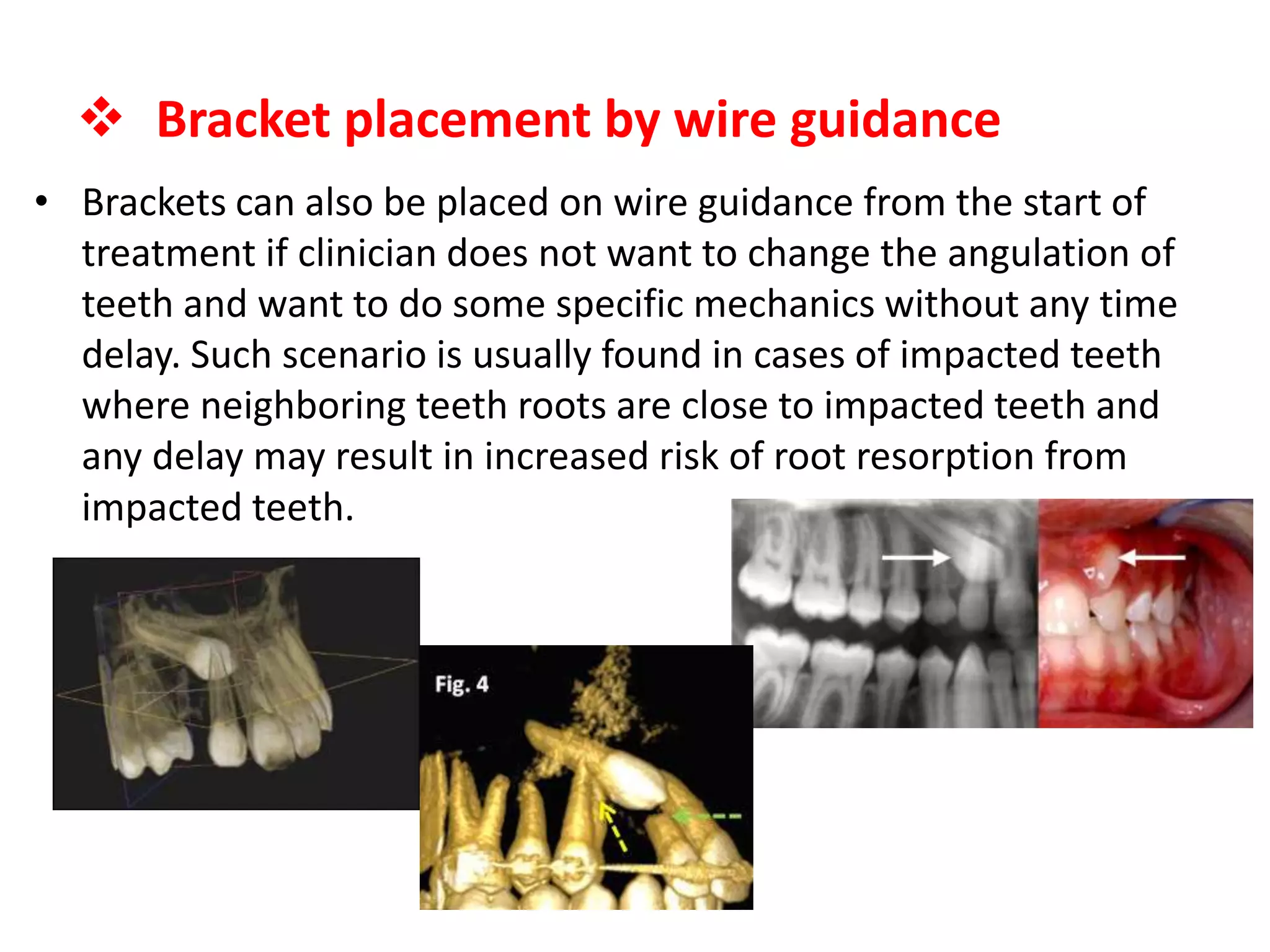 • Brackets can also be placed on wire guidance from the start of
treatment if clinician does not want to change the angulation of
teeth and want to do some specific mechanics without any time
delay. Such scenario is usually found in cases of impacted teeth
where neighboring teeth roots are close to impacted teeth and
any delay may result in increased risk of root resorption from
impacted teeth.
 Bracket placement by wire guidance
 
