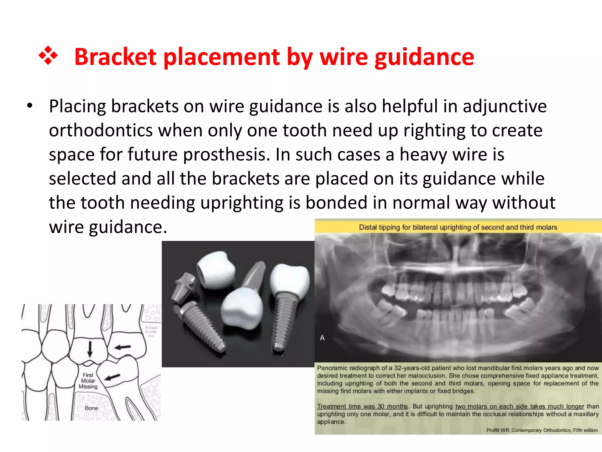 • Placing brackets on wire guidance is also helpful in adjunctive
orthodontics when only one tooth need up righting to create
space for future prosthesis. In such cases a heavy wire is
selected and all the brackets are placed on its guidance while
the tooth needing uprighting is bonded in normal way without
wire guidance.
 Bracket placement by wire guidance
 