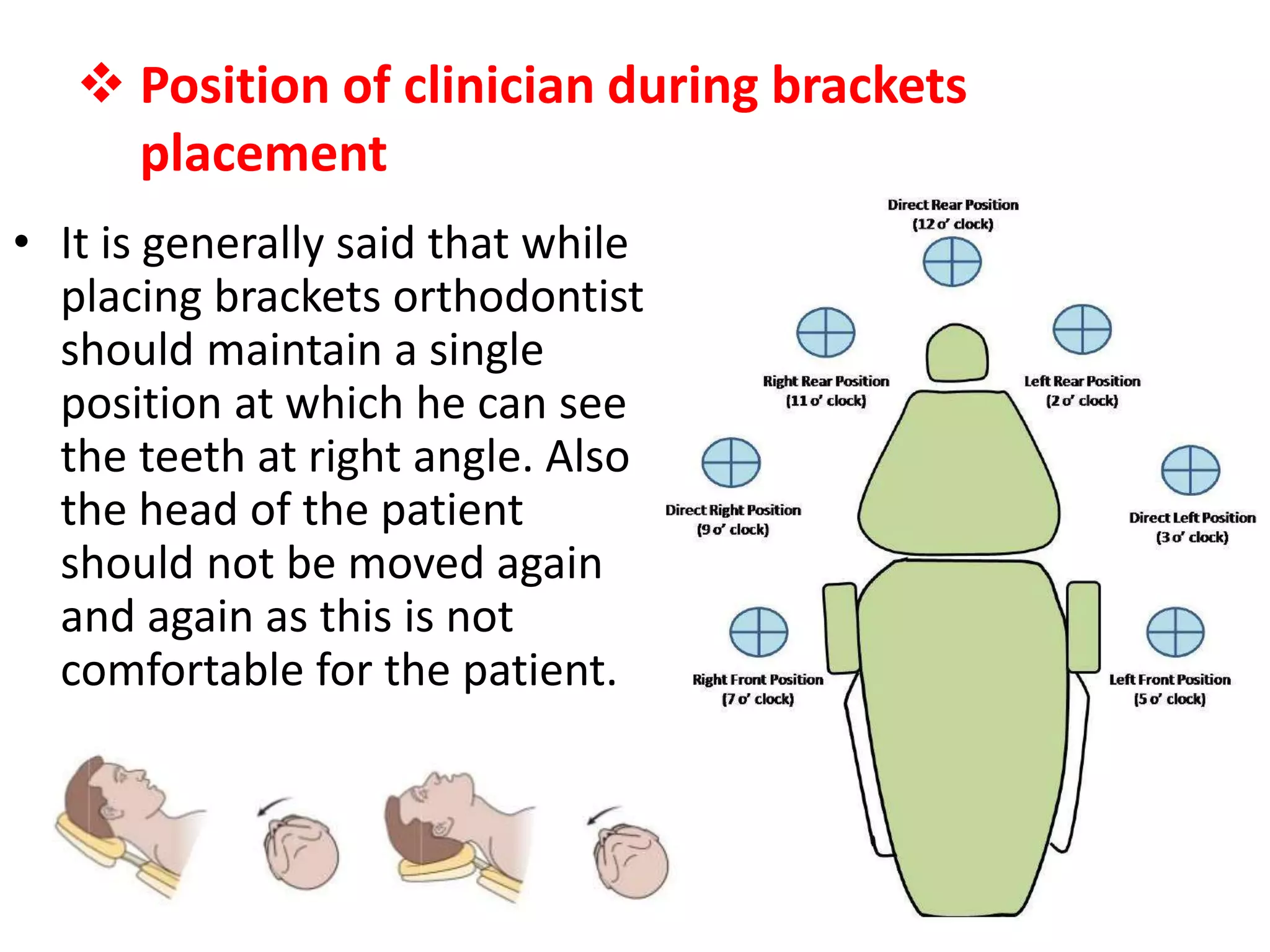  Position of clinician during brackets
placement
• It is generally said that while
placing brackets orthodontist
should maintain a single
position at which he can see
the teeth at right angle. Also
the head of the patient
should not be moved again
and again as this is not
comfortable for the patient.
 