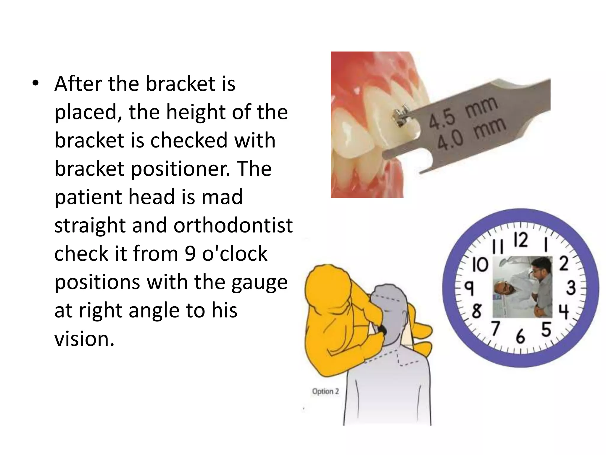 • After the bracket is
placed, the height of the
bracket is checked with
bracket positioner. The
patient head is mad
straight and orthodontist
check it from 9 o'clock
positions with the gauge
at right angle to his
vision.
 