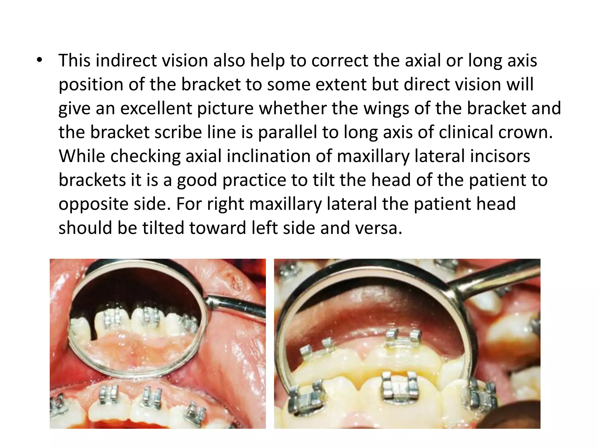 • This indirect vision also help to correct the axial or long axis
position of the bracket to some extent but direct vision will
give an excellent picture whether the wings of the bracket and
the bracket scribe line is parallel to long axis of clinical crown.
While checking axial inclination of maxillary lateral incisors
brackets it is a good practice to tilt the head of the patient to
opposite side. For right maxillary lateral the patient head
should be tilted toward left side and versa.
 