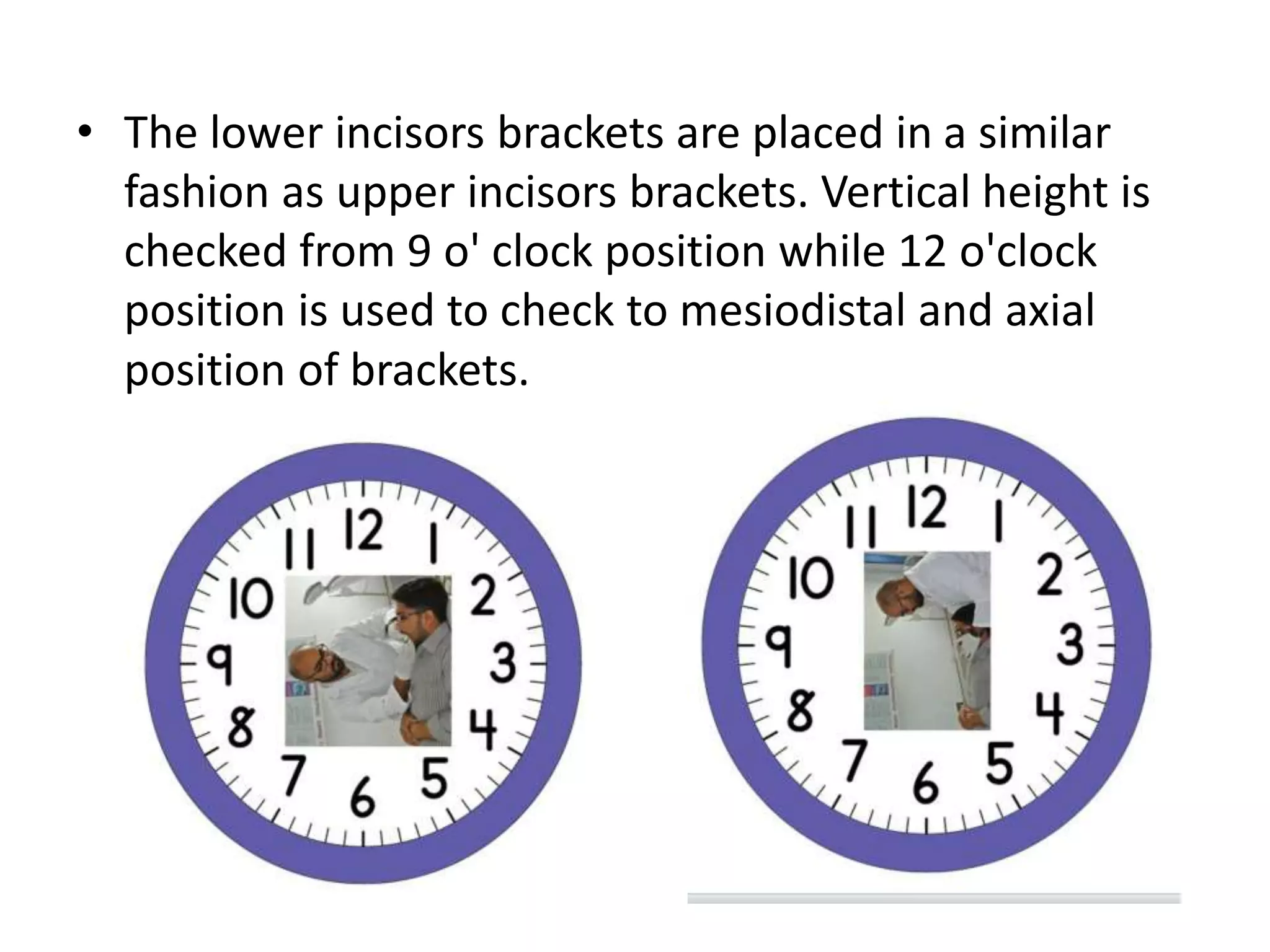 • The lower incisors brackets are placed in a similar
fashion as upper incisors brackets. Vertical height is
checked from 9 o' clock position while 12 o'clock
position is used to check to mesiodistal and axial
position of brackets.
 