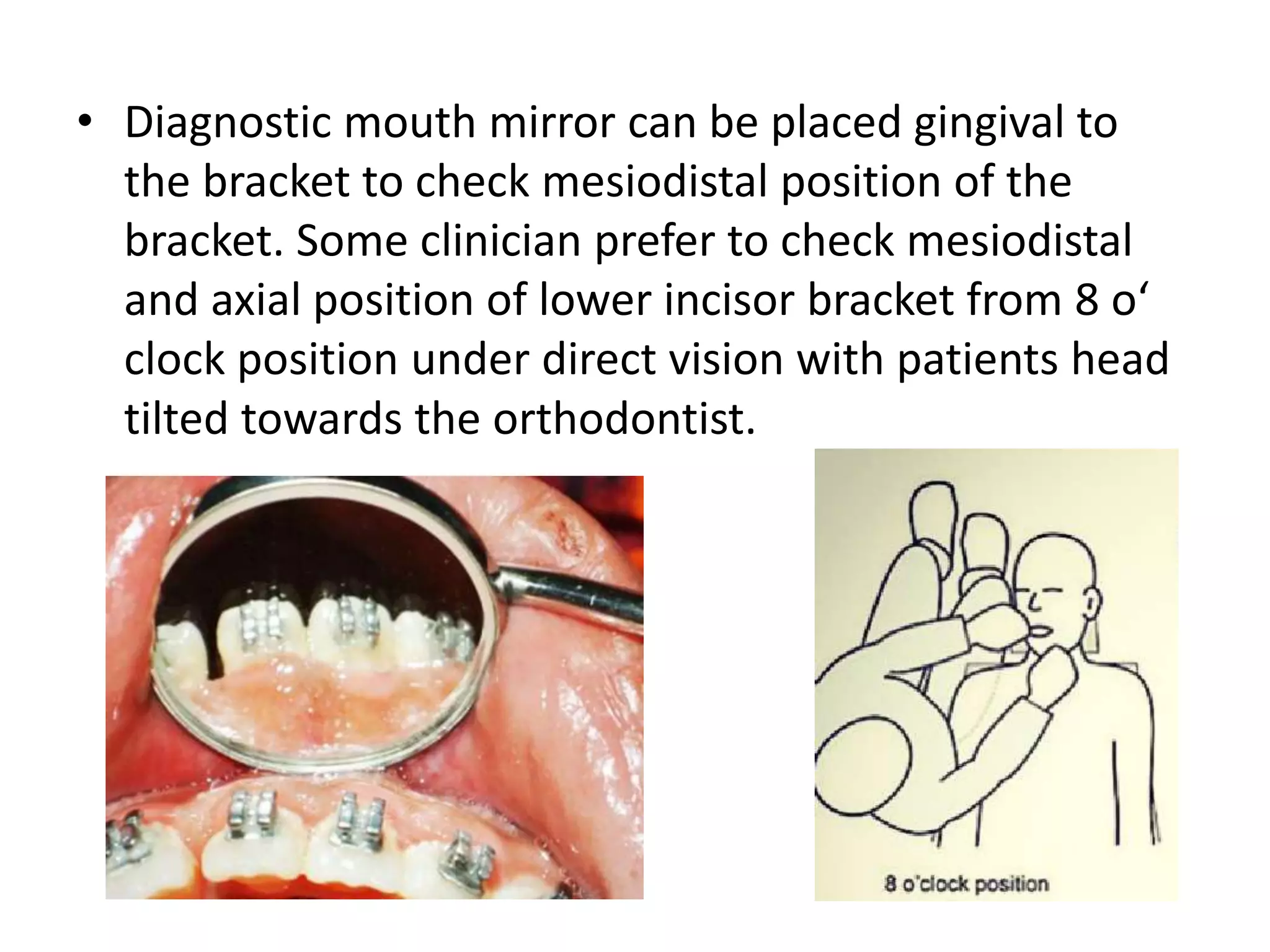 • Diagnostic mouth mirror can be placed gingival to
the bracket to check mesiodistal position of the
bracket. Some clinician prefer to check mesiodistal
and axial position of lower incisor bracket from 8 o‘
clock position under direct vision with patients head
tilted towards the orthodontist.
 