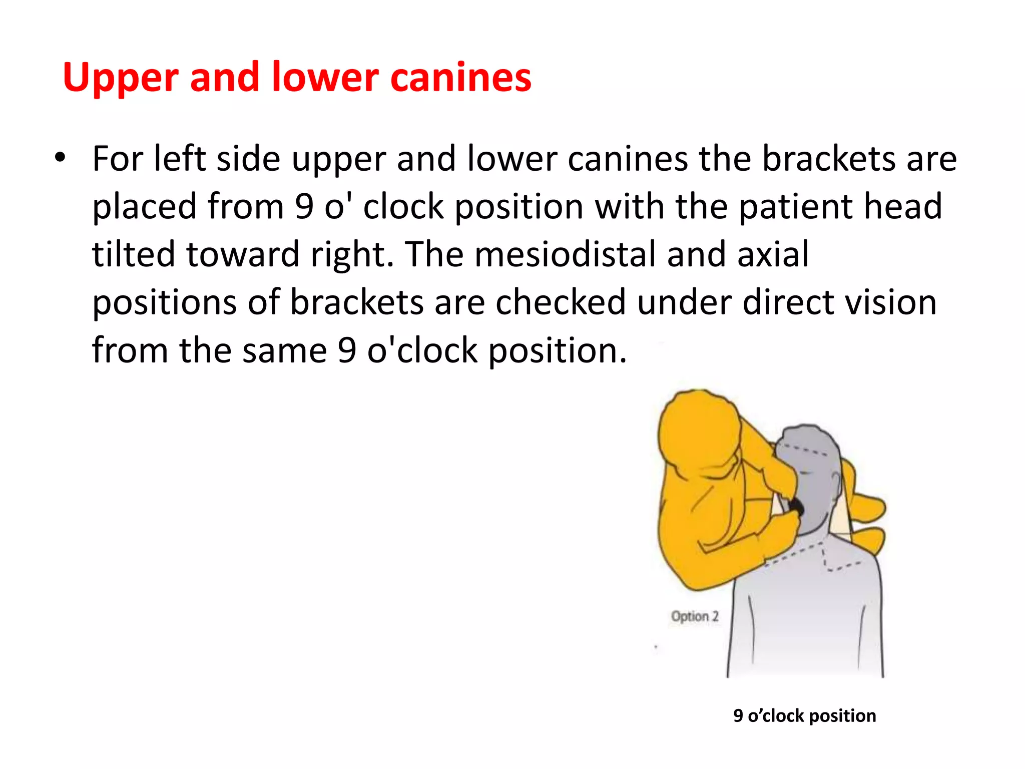 • For left side upper and lower canines the brackets are
placed from 9 o' clock position with the patient head
tilted toward right. The mesiodistal and axial
positions of brackets are checked under direct vision
from the same 9 o'clock position.
Upper and lower canines
9 o’clock position
 