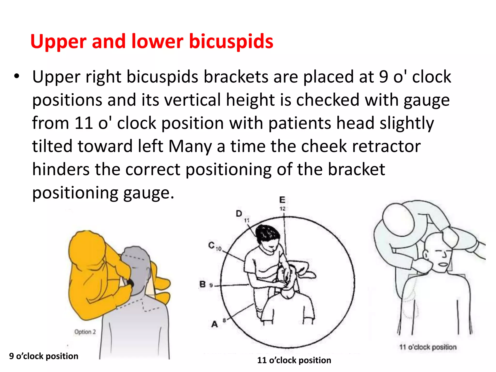 Upper and lower bicuspids
• Upper right bicuspids brackets are placed at 9 o' clock
positions and its vertical height is checked with gauge
from 11 o' clock position with patients head slightly
tilted toward left Many a time the cheek retractor
hinders the correct positioning of the bracket
positioning gauge.
9 o’clock position 11 o’clock position
 
