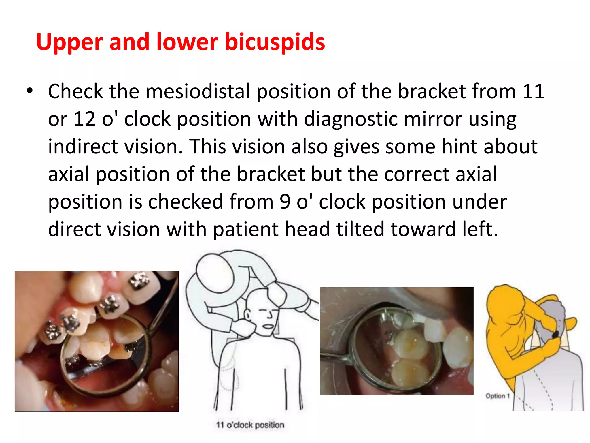 • Check the mesiodistal position of the bracket from 11
or 12 o' clock position with diagnostic mirror using
indirect vision. This vision also gives some hint about
axial position of the bracket but the correct axial
position is checked from 9 o' clock position under
direct vision with patient head tilted toward left.
Upper and lower bicuspids
 