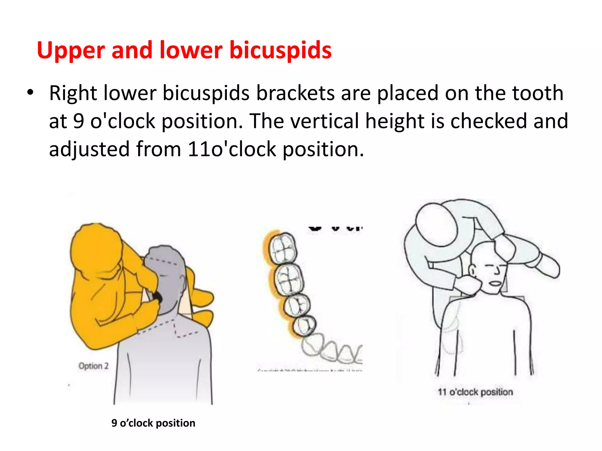 • Right lower bicuspids brackets are placed on the tooth
at 9 o'clock position. The vertical height is checked and
adjusted from 11o'clock position.
Upper and lower bicuspids
9 o’clock position
 