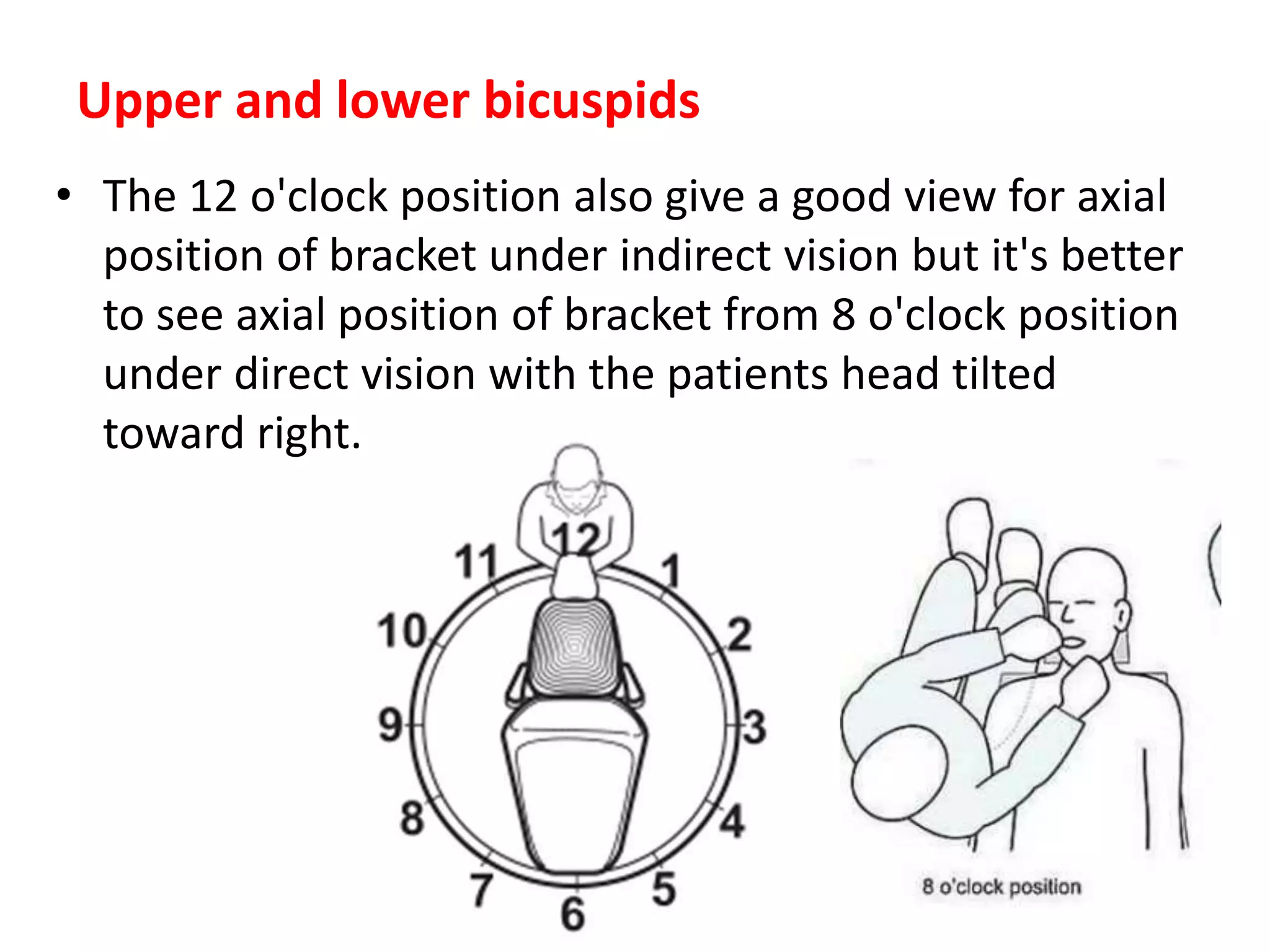 • The 12 o'clock position also give a good view for axial
position of bracket under indirect vision but it's better
to see axial position of bracket from 8 o'clock position
under direct vision with the patients head tilted
toward right.
Upper and lower bicuspids
 