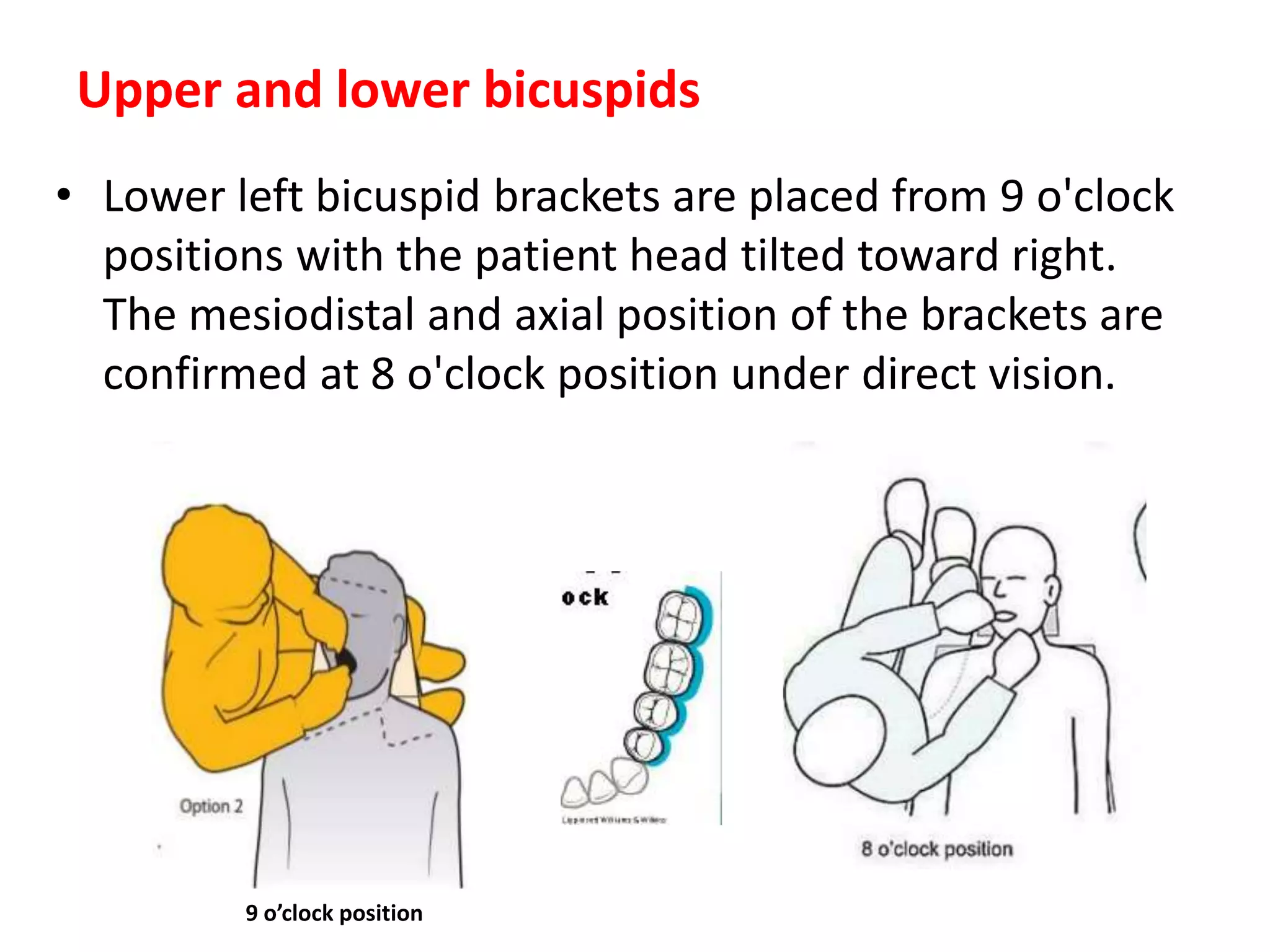 • Lower left bicuspid brackets are placed from 9 o'clock
positions with the patient head tilted toward right.
The mesiodistal and axial position of the brackets are
confirmed at 8 o'clock position under direct vision.
Upper and lower bicuspids
9 o’clock position
 