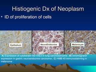 Histiogenic Dx of Neoplasm
• ID of proliferation of cells

Epithelium

NeuroEndocrine

Melanocyte

A) Expression of cytokeratin AE1/AE3 in lung carcinosarcoma ; B) chromogranin
expression in gastric neuroendocrine carcinoma ; C) HMB 45 immunostainning in
melanoma .

 