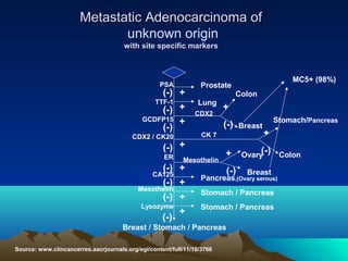 Metastatic Adenocarcinoma of
unknown origin
with site specific markers

PSA

(-) +
TTF-1
(-) +
GCDFP15 +
(-)
CDX2 / CK20

Colon
Lung
CDX2
CK 7

Mesothelin

(-) +
(-) +
Mesothelin
(-) +
Lysozyme
+
(-)
CA125

+
(-)

(-) +
ER

MC5+ (98%)

Prostate

+

Breast

Stomach/Pancreas

+

(-)
Ovary

(-)

Breast
Pancreas,(Ovary serous)
Stomach / Pancreas
Stomach / Pancreas

Breast / Stomach / Pancreas
Source: www.clincancerres.aacrjournals.org/egi/content/full/11/10/3766

Colon

 