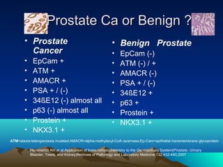 Prostate Ca or Benign ?
• Prostate
Cancer
•
•
•
•
•
•
•
•

EpCam +
ATM +
AMACR +
PSA + / (-)
34ßE12 (-) almost all
p63 (-) almost all
Prostein +
NKX3.1 +

• Benign Prostate
•
•
•
•
•
•
•
•

EpCam (-)
ATM (-) / +
AMACR (-)
PSA + / (-)
34ßE12 +
p63 +
Prostein +
NKX3.1 +

ATM=ataxia-telangiectasia mutated;AMACR=alpha-methylacyl-CoA racemase;Ep-Cam=epithelial transmembrane glycoprotein
Hammerich KH et al.Application of Immunohistochemistry to the Genitourinary System(Prostate, Urinary
Bladder, Testis, and Kidney)Archives of Pathology and Laboratory Medicine;132:432-440,2007

 
