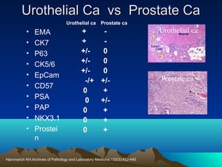 Urothelial Ca vs Prostate Ca
Urothelial ca

•
•
•
•
•
•
•
•
•
•

EMA
CK7
P63
CK5/6
EpCam
CD57
PSA
PAP
NKX3.1
Prostei
n

Prostate ca

+
+
+/0
+/0
+/0
-/+ +/0
+
0
+/0
+
0
+
0
+

Hammerich KH.Archives of Pathology and Laboratory Medicine;132(3):432-440

Urothelial ca

Prostate ca

 