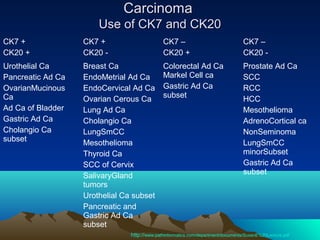 Carcinoma
Use of CK7 and CK20
CK7 +
CK20 +

CK7 +
CK20 -

CK7 –
CK20 +

CK7 –
CK20 -

Urothelial Ca
Pancreatic Ad Ca
OvarianMucinous
Ca
Ad Ca of Bladder
Gastric Ad Ca
Cholangio Ca
subset

Breast Ca
EndoMetrial Ad Ca
EndoCervical Ad Ca
Ovarian Cerous Ca
Lung Ad Ca
Cholangio Ca
LungSmCC
Mesothelioma
Thyroid Ca
SCC of Cervix
SalivaryGland
tumors
Urothelial Ca subset
Pancreatic and
Gastric Ad Ca
subset

Colorectal Ad Ca
Markel Cell ca
Gastric Ad Ca
subset

Prostate Ad Ca
SCC
RCC
HCC
Mesothelioma
AdrenoCortical ca
NonSeminoma
LungSmCC
minorSubset
Gastric Ad Ca
subset

http://www.pathinformatics.com/department/documents/SusanE%20Lecture.pdf

 