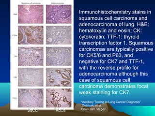 Immunohistochemistry stains in
squamous cell carcinoma and
adenocarcinoma of lung. H&E:
hematoxylin and eosin; CK:
cytokeratin; TTF-1: thyroid
transcription factor 1. Squamous
carcinomas are typically positive
for CK5/6 and P63, and
negative for CK7 and TTF-1,
with the reverse profile for
adenocarcinoma although this
case of squamous cell
carcinoma demonstrates focal
weak staining for CK7.

SqCC

AdCa

“Ancillary Testing in Lung Cancer Diagnosis”
Dublinski et al.
Openi.nlm.nih.gov

 