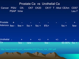 Prostate Ca vs Urothelial Ca
Cancer PSA/ CKPSAP hmw

CK7 CK20

Prostate
+
Adenoca few -

few +

foc +

foc +

Urothelial Ca

+
few -

+
rare -

+/-

CK17 T -Mod CEAm CD57
Leu 7

6%+

-

foc +

+
few -

+/-

+
60-90% foc +

http://www.ihcworld.com/_newsletter/2001/focus_mar_2001.pdf

+
few-

 