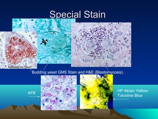 Special Stain

Antibody for Yeast

Budding yeast GMS Stain and H&E (Blastomycosis).

AFB

HP Alcian YellowToluidine Blue

 