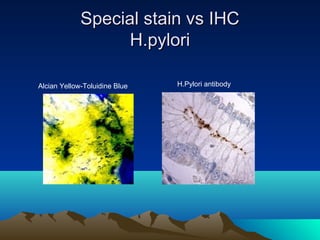 Special stain vs IHC
H.pylori
Alcian Yellow-Toluidine Blue

H.Pylori antibody

 