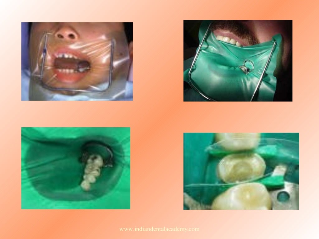 Moisture control /certified fixed orthodontic courses by Indian denta…