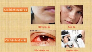 Các bệnh ngoài da
Các bệnh về mắt
Nấm,mốc da Sạm da
Viêm loét giác mạc Suy giảm thị lực
 