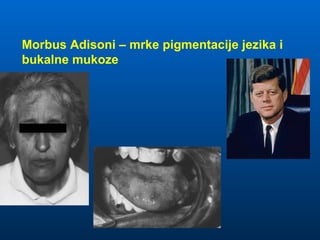 Morbus Adisoni – mrke pigmentacije jezika i
bukalne mukoze
 