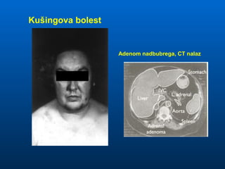 Kušingova bolest
Adenom nadbubrega, CT nalaz
 