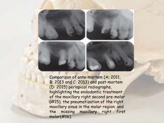 Comparison of ante-mortem (A: 2011,
B: 2013 and C: 2013) and post-mortem
(D: 2015) periapical radiographs,
highlighting the endodontic treatment
of the maxillary right second pre-molar
(#15); the pneumatization of the right
maxillary sinus in the molar region; and
the missing maxillary right first
molar(#16).
 