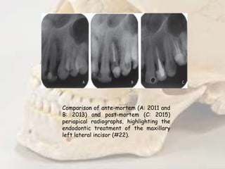 Comparison of ante-mortem (A: 2011 and
B: 2013) and post-mortem (C: 2015)
periapical radiographs, highlighting the
endodontic treatment of the maxillary
left lateral incisor (#22).
 