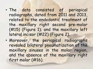 • The data consisted of periapical
radiographs, dated from 2011 and 2013,
related to the endodontic treatment of
the maxillary right second pre-molar
(#15) (Figure 1); and the maxillary left
lateral incisor (#22) (Figure 2).
• Moreover, the periapical radiographs
revealed bilateral pneumatization of the
maxillary sinuses in the molar region,
and the absence of the maxillary right
first molar (#16).
 