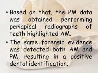 • Based on that, the PM data
was obtained performing
periapical radiographs of
teeth highlighted AM.
• The same forensic evidence
was detected both AM and
PM, resulting in a positive
dental identification.
 