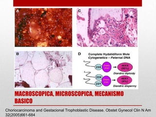 MOLA COMPLETA
    IMAGEN
    MACROSCOPICA, MICROSCOPICA, MECANISMO
    BASICO
Choriocarcinoma and Gestacional Trophoblastic Disease. Obstet Gynecol Clin N Am
32(2005)661-684
 