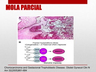 MOLA PARCIAL




Choriocarcinoma and Gestacional Trophoblastic Disease. Obstet Gynecol Clin N
Am 32(2005)661-684
 