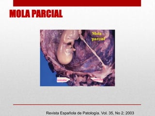MOLA PARCIAL




        Revista Española de Patología. Vol. 35, No 2; 2003
 
