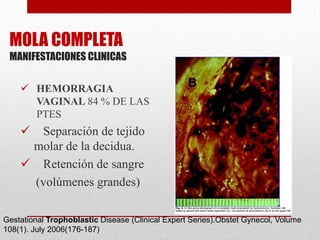 MOLA COMPLETA
 MANIFESTACIONES CLINICAS

     HEMORRAGIA
      VAGINAL 84 % DE LAS
      PTES
     Separación de tejido
     molar de la decidua.
     Retención de sangre
     (volúmenes grandes)

Gestational Trophoblastic Disease (Clinical Expert Series).Obstet Gynecol, Volume
108(1). July 2006(176-187)
 