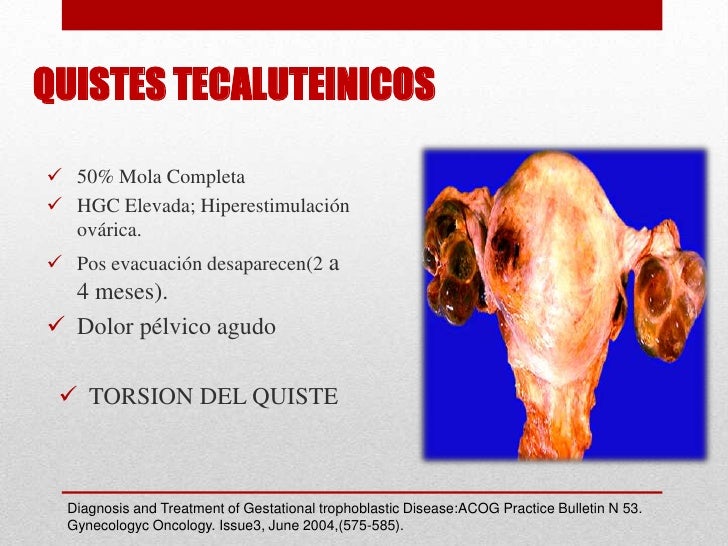 Tratamiento de quistes tecaluteinicos