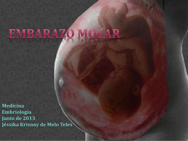 Embarazo Buscar Molar Embarazo Buscar Molar