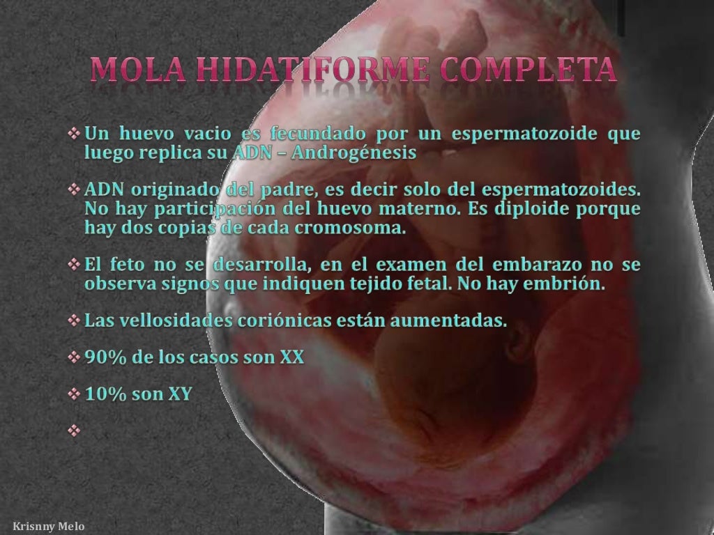 Embarazo Molar Mola Hidatiforme