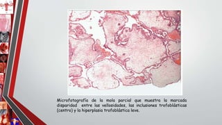 Microfotografía de la mola parcial que muestra la marcada
disparidad entre las vellosidades, las inclusiones trofoblásticas
(centro) y la hiperplasia trofoblástica leve.
 
