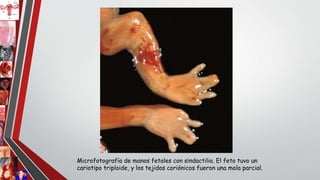 Microfotografía de manos fetales con sindactilia. El feto tuvo un
cariotipo triploide, y los tejidos coriónicos fueron una mola parcial.
 