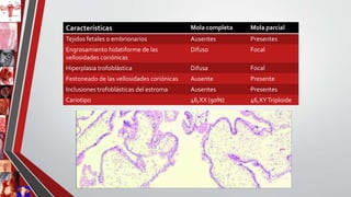 Características Mola completa Mola parcial
Tejidos fetales o embrionarios Ausentes Presentes
Engrosamiento hidatiforme de las
vellosidades coriónicas
Difuso Focal
Hiperplasia trofoblástica Difusa Focal
Festoneado de las vellosidades coriónicas Ausente Presente
Inclusiones trofoblásticas del estroma Ausentes Presentes
Cariotipo 46,XX (90%) 46,XYTriploide
 