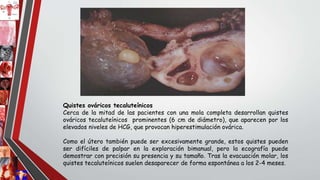 Quistes ováricos tecaluteínicos
Cerca de la mitad de las pacientes con una mola completa desarrollan quistes
ováricos tecaluteínicos prominentes (6 cm de diámetro), que aparecen por los
elevados niveles de HCG, que provocan hiperestimulación ovárica.
Como el útero también puede ser excesivamente grande, estos quistes pueden
ser difíciles de palpar en la exploración bimanual, pero la ecografía puede
demostrar con precisión su presencia y su tamaño. Tras la evacuación molar, los
quistes tecaluteínicos suelen desaparecer de forma espontánea a los 2-4 meses.
 