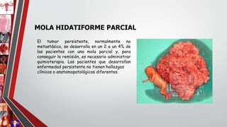 MOLA HIDATIFORME PARCIAL
El tumor persistente, normalmente no
metastásico, se desarrolla en un 2 a un 4% de
las pacientes con una mola parcial y, para
conseguir la remisión, es necesario administrar
quimioterapia. Las pacientes que desarrollan
enfermedad persistente no tienen hallazgos
clínicos o anatomopatológicos diferentes.
 