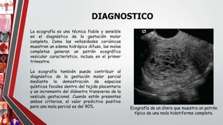 La ecografía es una técnica fiable y sensible
en el diagnóstico de la gestación molar
completa. Como las vellosidades coriónicas
muestran un edema hidrópico difuso, las molas
completas generan un patrón ecográfico
vesicular característico, incluso en el primer
trimestre.
La ecografía también puede contribuir al
diagnóstico de la gestación molar parcial
mediante la demostración de espacios
quísticos focales dentro del tejido placentario
y un incremento del diámetro transverso de la
vesícula gestacional. Cuando están presentes
ambos criterios, el valor predictivo positivo
para una mola parcial es del 90%.
DIAGNOSTICO
Ecografía de un útero que muestra un patrón
típico de una mola hidatiforme completa.
 