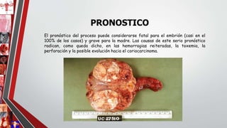 PRONOSTICO
El pronóstico del proceso puede considerarse fatal para el embrión (casi en el
100% de los casos) y grave para la madre. Las causas de este serio pronóstico
radican, como queda dicho, en las hemorragias reiteradas, la toxemia, la
perforación y la posible evolución hacia el coriocarcinoma.
 