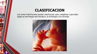 Las molas hidatiformes pueden clasificarse como completas o parciales
según su morfología macroscópica, su histología y su cariotipo
CLASIFICACION
 