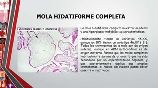 La mola hidatiforme completa muestra un edema
y una hiperplasia trofoblástica característicos
.
Habitualmente tienen un cariotipo 46,XX,
aunque un 10% tienen un cariotipo 46,XY ( 9 ).
Todos los cromosomas de la mola son de origen
paterno, aunque el ADN mitocondrial es de
origen materno. Parece que las molas completas
habitualmente surgen de un ovocito que ha sido
fecundado por un espermatozoide haploide, y
que posteriormente duplica sus propios
cromosomas. El núcleo del ovocito puede estar
ausente o inactivado.
MOLA HIDATIFORME COMPLETA
 