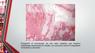 Fotografía al microscopio de una mola completa que muestra
vellosidades aumentadas de tamaño, con cavitación central e hiperplasia
trofoblástica alrededor.
 