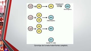 Cariotipo de la mola hidatiforme completa.
 