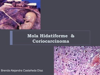 Mola Hidatiforme &
Coriocarcinoma
Brenda Alejandra Castañeda Díaz
 