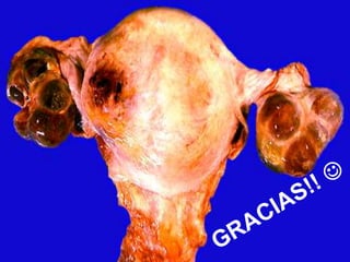 Mola hidatiforme & coriocarcinoma